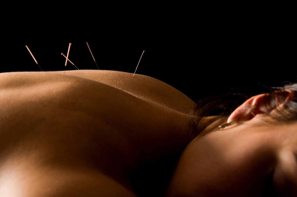 Une femme allongé sur le dos lors d'une séance acupuncture